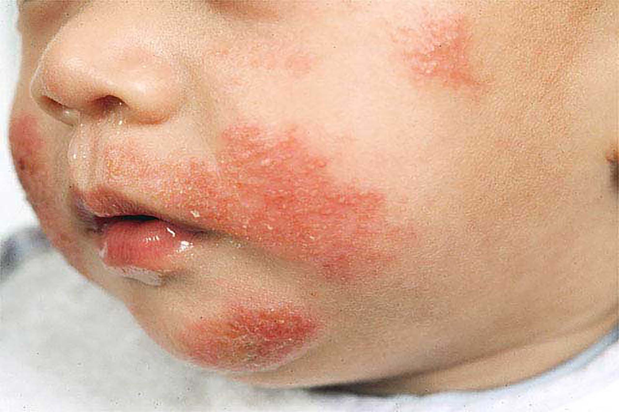 Skin Allergy Allergy Medik