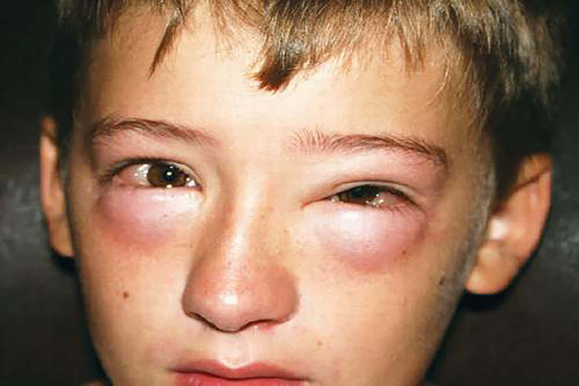 Anaphylaxis Allergy Medik